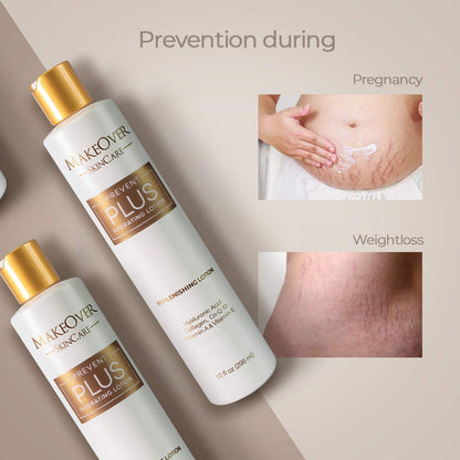 Prevent Plus Hydrating Lotion, Stretch Mark & Scar Care, 1oz